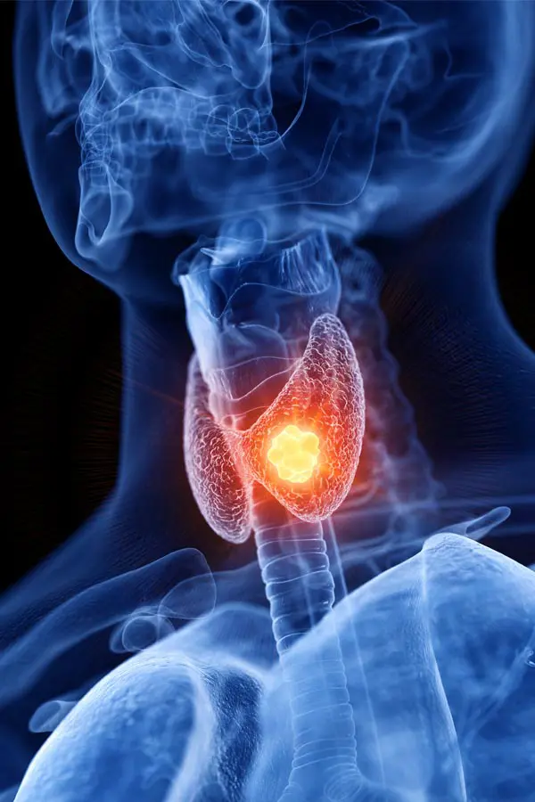 Thyroid-Imbalance-Treatment A 3D illustration of an x-ray of a human neck, highlighting the thyroid. Get help with thyroid imbalance from Anita Petruzzelli, M.D. in Glastonbury.